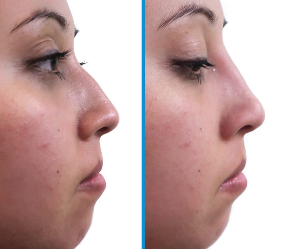 Nariz Bonita - Transforma tu Nariz sin Cirugía - PROMO 2x1 $ 24.99